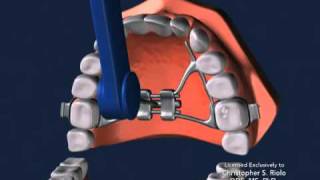 Seattle Orthodontist Dr Christopher Riolo Banded Expander RPE [upl. by Frech]