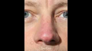 Couperose of the Nose Intense Pulsed Light IPL Treatment [upl. by Garrison365]