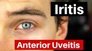 Iritis  What is Anterior Uveitis Doctor Explains [upl. by Itsuj275]