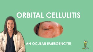 Orbital Cellulitis an ocular emergency [upl. by Anner]