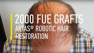 Hair transplant 2000 FUE Grafts ARTAS® Robotic Hair Restoration  Hair By Dr Max [upl. by Ahsea828]