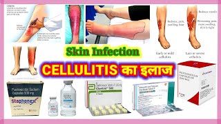 Cellulitis  Cellulitis Treatment  Cellulitis Of The Legs  Cellulitis Skin Infection  Dr Vijay [upl. by Nerrak379]