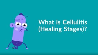 Cellulitis Healing Stages [upl. by Atekan220]