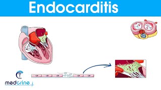 Endocarditis  causes symptoms pathophysiology diagnosis and treatment [upl. by Noell471]