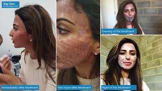 CO2 Laser Resurfacing treatment at London Laser Clinic [upl. by Attiuqihc32]