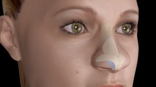 Bulbous Large Nasal Tip Nose Job Rhinoplasty [upl. by Eiltan388]