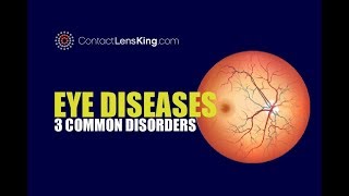 Eye Diseases  3 Common Eye Conditions [upl. by Honeyman]