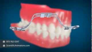 Rapid Palatal Expansion  Dental Implant Procedure [upl. by Clarissa]