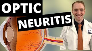 Optic Neuritis Symptoms Diagnosis and Treatment [upl. by Leba]