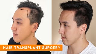 Hair Transplant Forehead Reduction Procedure for Traction Alopecia  Dr Matt Huebner Mela [upl. by Shanan122]