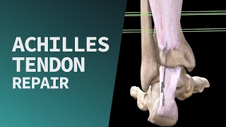 Achilles Tendon Repair [upl. by Iana]