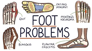 Common Foot Problems [upl. by Aztiley]