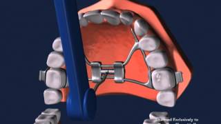 Advanced Orthodontics  Expanders [upl. by Nylssej]