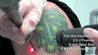 QSwitched Ruby Laser  Astanza Eternity Tattoo Removal Laser [upl. by Ydnor]