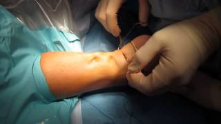 Percutaneous Achilles Tendon Surgery Repair Unedited by Kevin R Stone MD [upl. by Pond]