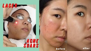 Picosure Laser for Acne Scars amp Hyperpigmentation Before amp After [upl. by Oidivo]