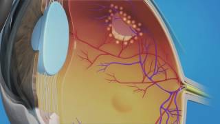 Prophylactic Laser Photocoagulation Laserpexy for Retinal Tear [upl. by Fraase699]