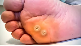 How To Remove a Foot Corn or Callus Foot Doctor Home Treatment [upl. by Akihsat21]