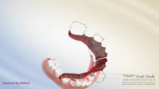 Schwartz Appliance  Lower Expander  Orthodontic Treatment [upl. by Sherrie646]