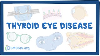 Thyroid Eye Disease causes symptoms diagnosis treatment pathology [upl. by Laveen]