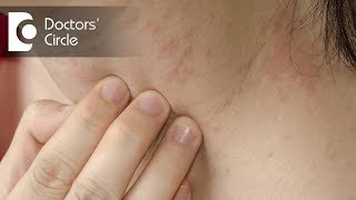 How to identify scabies rash amp its management  Dr Sudheendra Udbalker [upl. by Notsehc996]