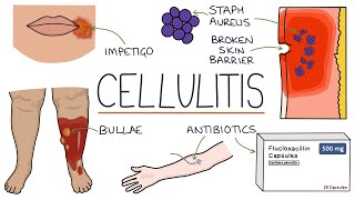 Understanding Cellulitis Skin and Soft Tissue Infections [upl. by Gustav626]