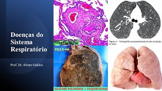 DPOC I Doença estável  PNEUMOLOGIA [upl. by Zohara]