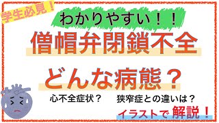 僧帽弁閉鎖不全症についてわかりやすく解説！〜心不全症状がみられる理由や心房細動になる理由とは〜 [upl. by Ylsew]