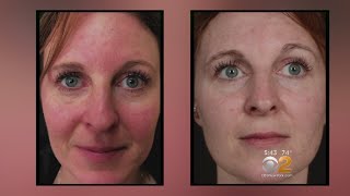 Health Watch New Laser Treatment For Rosacea [upl. by Morganstein]