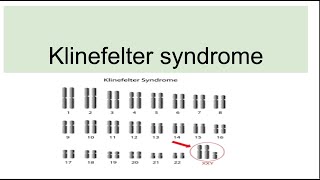 Klinefelter syndromeGenetics Characteristics Diagnosis [upl. by Dduj]