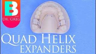 Quad Helix Expander for Braces  Invisalign [upl. by Gabrielli41]