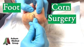 Foot Corn Surgery Treatment [upl. by Wendolyn576]