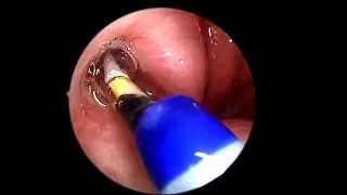 Eustachian Tube Balloon Dilation [upl. by Shargel]