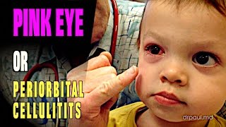 LIVE DIAGNOSIS Pink Eye or Periorbital Cellulitis  Dr Paul [upl. by Aimat19]