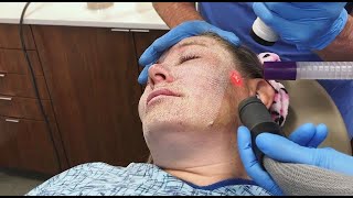 Full Face Fractional CO2 Laser Resurfacing for Wrinkles and Skin Tightening [upl. by Iznyl550]