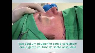 Rinoplastia Perfeita ANTES e DEPOIS  Cirurgia [upl. by Lunneta812]