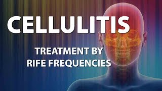 Cellulitis Bacterial infection  RIFE Frequencies Treatment  Energy amp Quantum Medicine [upl. by Ymarej]