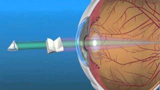 Multifocal Lens IOL [upl. by Lecram54]