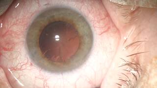 Floppy Iris Syndrome Cataract Surgery [upl. by Nahtan479]