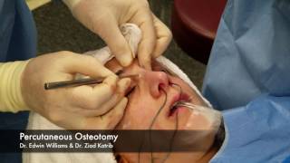 Percutaneous Osteotomy amp Breaking the Nose During Rhinoplasty Surgery [upl. by Sikorski845]