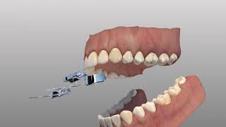 Rapid Palatal Expander [upl. by Tdnaltroc275]