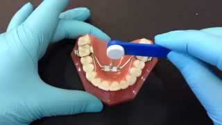 Palatal Expander Activation [upl. by Justin]