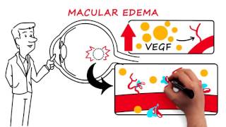 Retinal Vein Occlusion [upl. by Elrae]