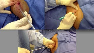 Chest Tube Placement [upl. by Votaw]