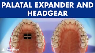 Orthodontic devices  Palatal expander and headgear © [upl. by Asilav91]