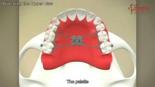 Widening the Upper Jaw  Palatal Expanders [upl. by Dnomad567]