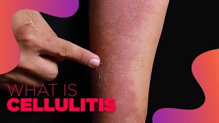 What is Cellulitis  Symptoms and Treatment Options [upl. by Adest]