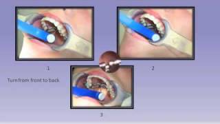 RPE Expander Instruction  Smile Solutions Orthodontists [upl. by Sachi]