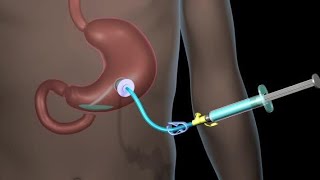 How to Do a Tube Feeding Bolus method [upl. by Cheston]